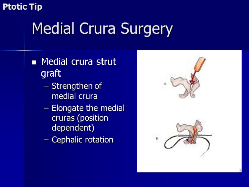 Medial Crura Surgery Medial crura strut graft Strengthen of medial crura Elongate the medial